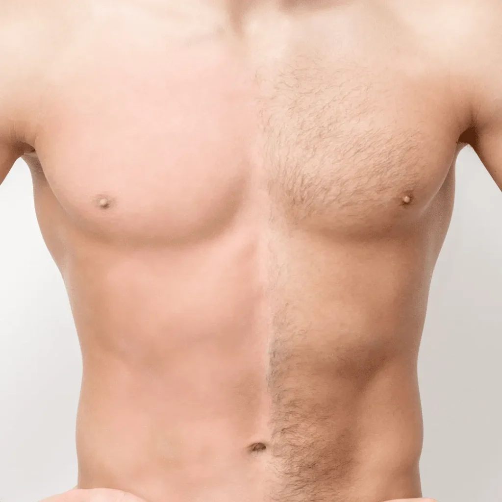 Depilación láser en pecho en hombre mostrando zona de torso para tratamiento