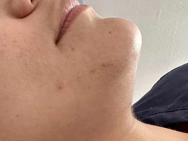 cuello y mentón femenino con piel lisa y suave resultado de depilación láser facial sin vello visible ni irritación