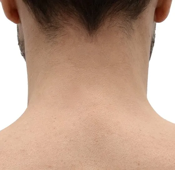 Depilación láser en nuca en hombre mostrando área posterior del cuello para tratamiento