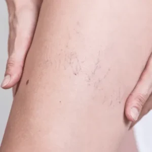 Escleroterapia (Arañas Vasculares)