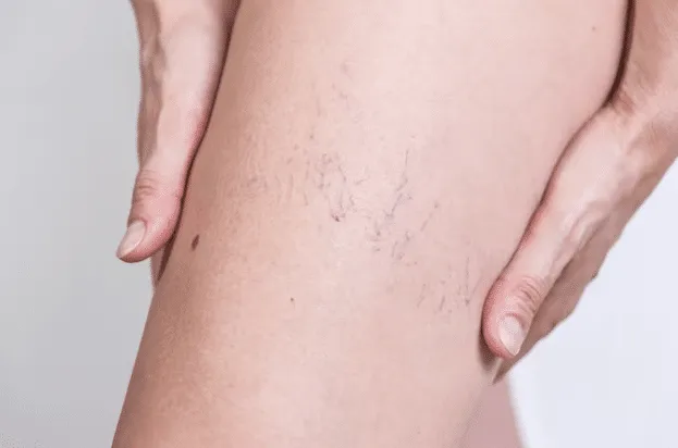 Escleroterapia (Arañas Vasculares)