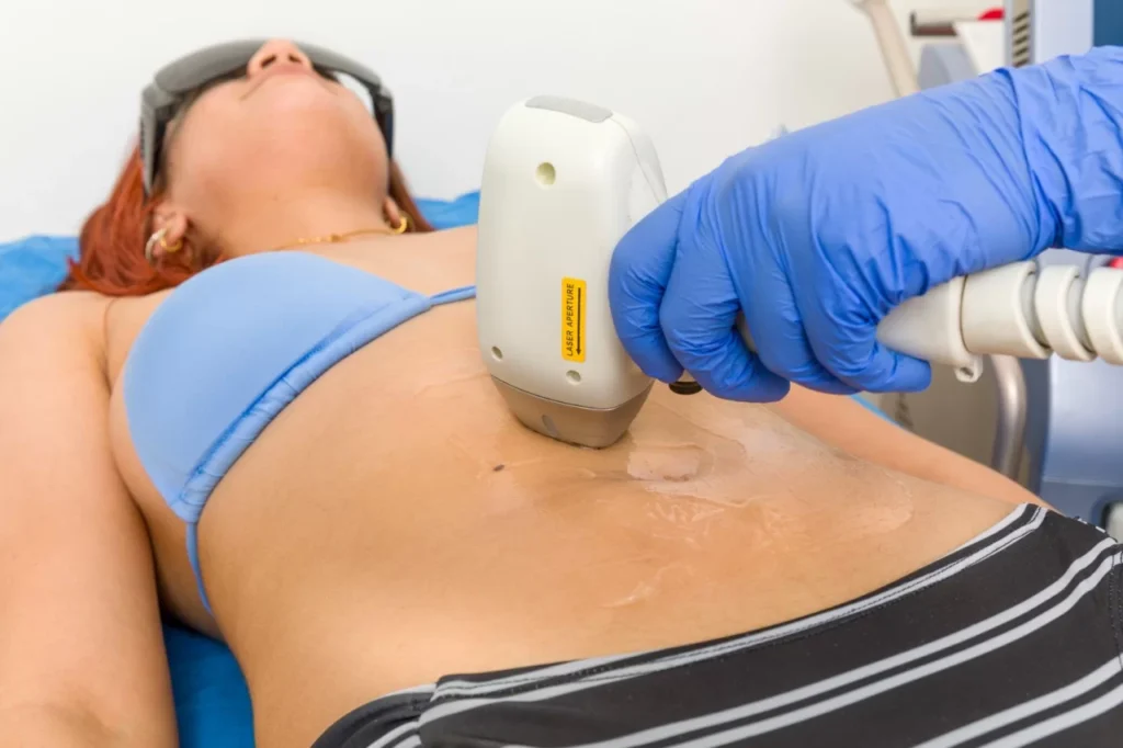 mujer recibiendo tratamiento de depilación láser en abdomen con equipo profesional para eliminación permanente del vello corporal
