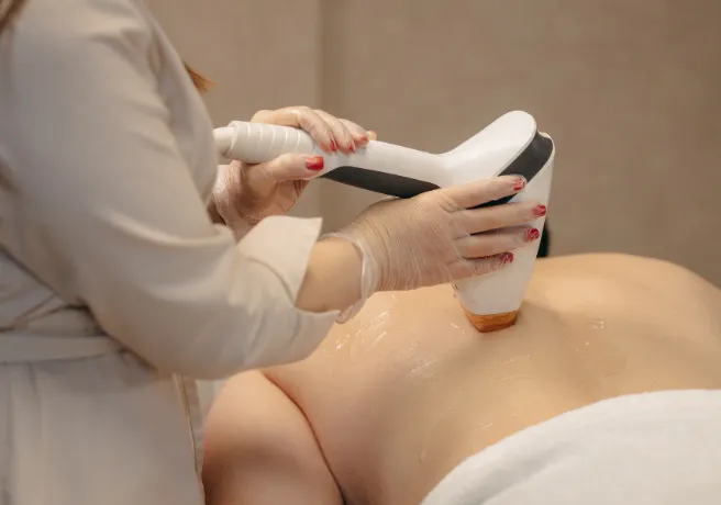 Depilación láser en espalda baja y zona lumbar en mujer con equipo profesional