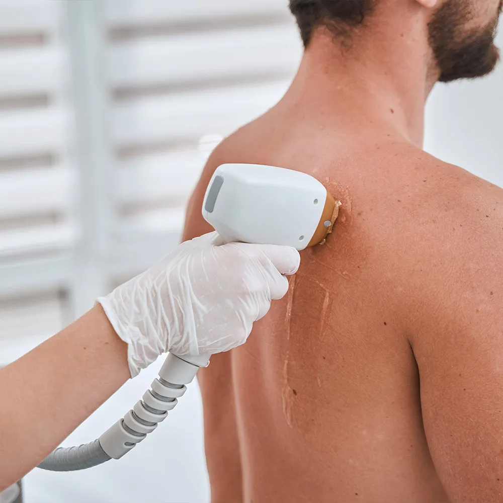 depilacion-laser-hombre-espalda-convertido-de-jpg
