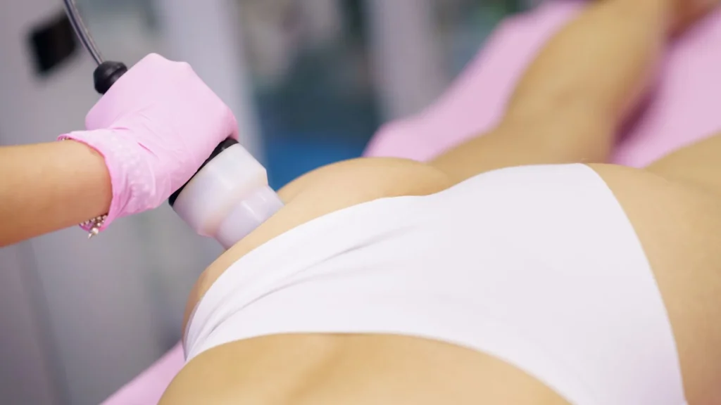 Depilación láser en glúteos en mujer con equipo de tecnología láser profesional