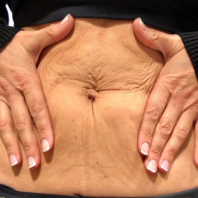 abdomen con flacidez y piel sobrante alrededor del ombligo antes de tratamiento reafirmante