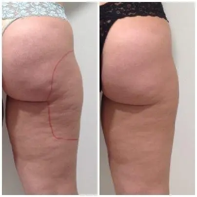 antes y después de tratamiento reductor en piernas y glúteos mostrando reducción de celulitis y flacidez