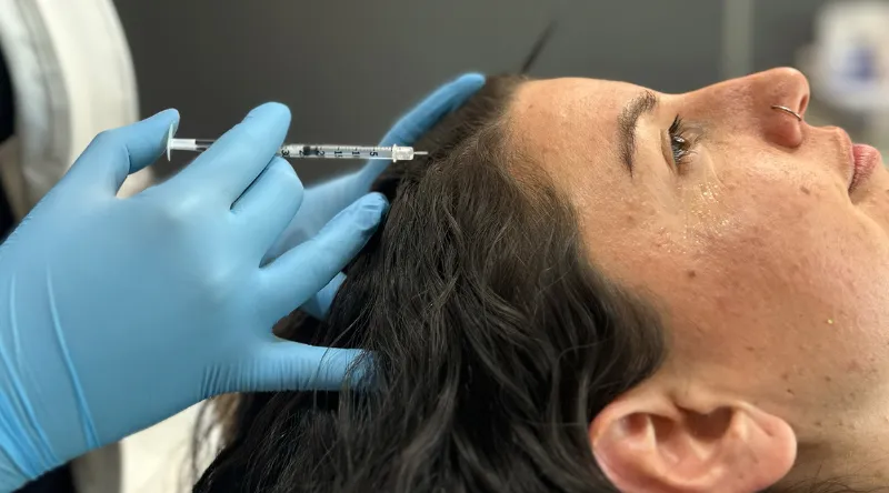 PRP capilar para prevenir la caída del cabello