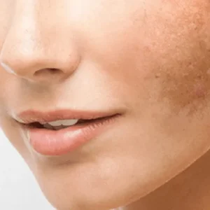 primer plano de rostro femenino con mancha epidérmica o hiperpigmentación visible en la piel del mentón y mejilla