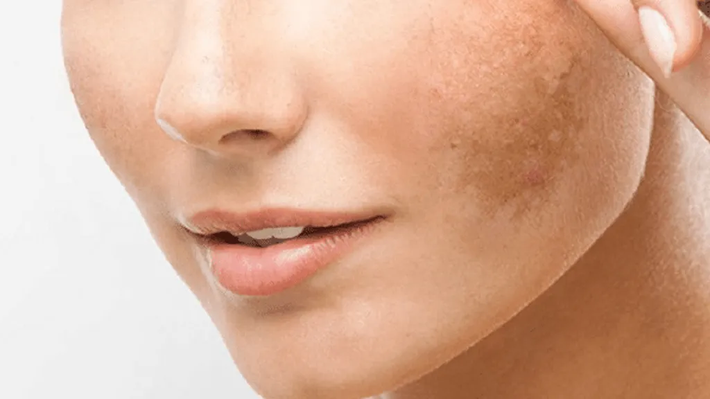 primer plano de rostro femenino con mancha epidérmica o hiperpigmentación visible en la piel del mentón y mejilla