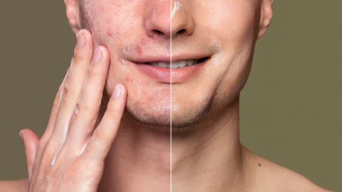 Tratamiento acné Murcia profesional para piel grasa y con imperfecciones