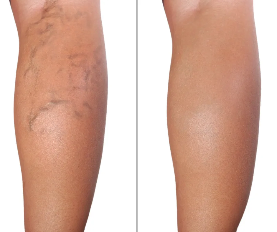 Escleroterapia para eliminar varices y mejorar la circulación