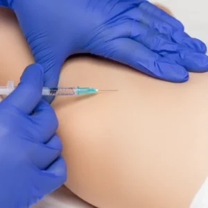 Antes y después de tratamiento de escleroterapia mostrando reducción de arañas vasculares.