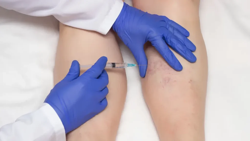 Aplicación del tratamiento de escleroterapia para reducir venitas superficiales.