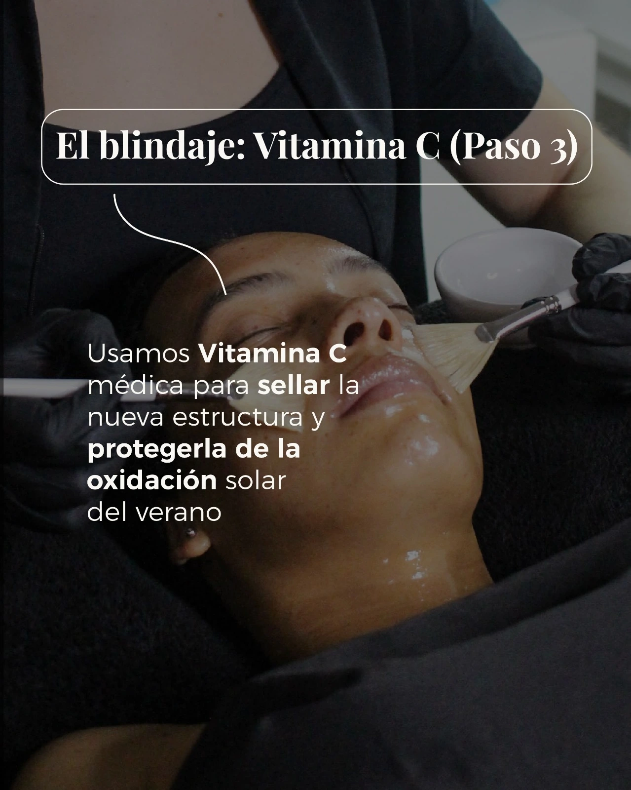 Tratamiento HIFU realizado para combatir la flacidez facial mediante ultrasonido focalizado. Técnica no invasiva que aporta firmeza y rejuvenecimiento visible desde la primera sesión.